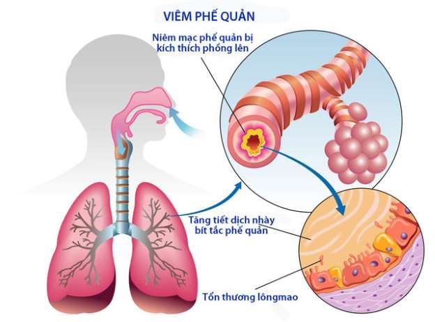 Tìm hiểu về bệnh án viêm phế quản ở người lớn